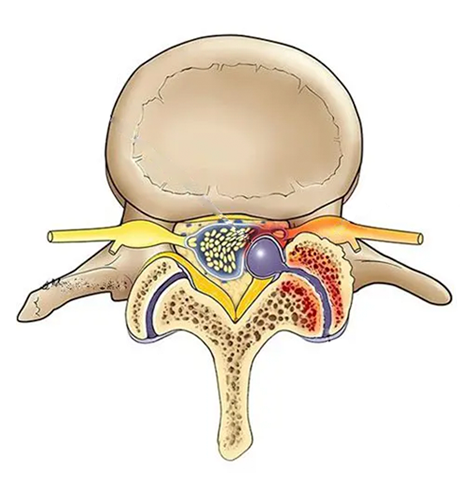 Cistos Facetários (Cisto na Coluna)