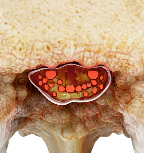 Estenose do Canal Lombar