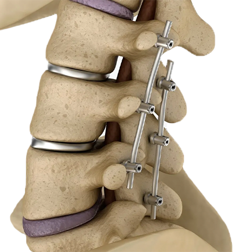 Fixação da Coluna para Espondilolistese