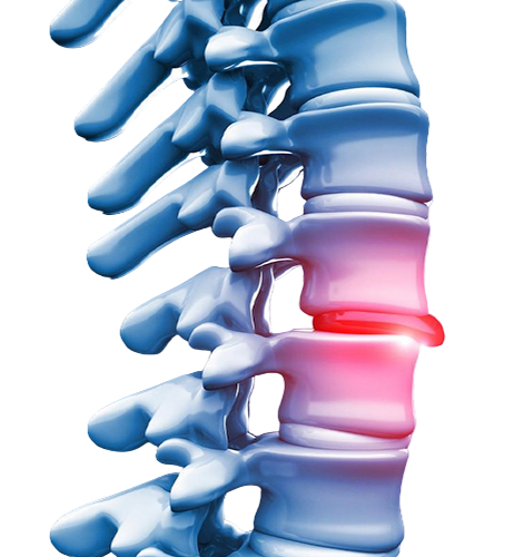 Hérnia de Disco Cervical