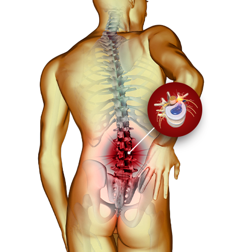 Hérnia de Disco Lombar