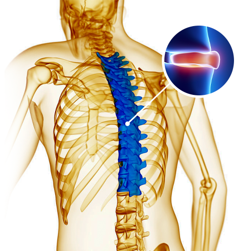 Hérnia de Disco Torácica