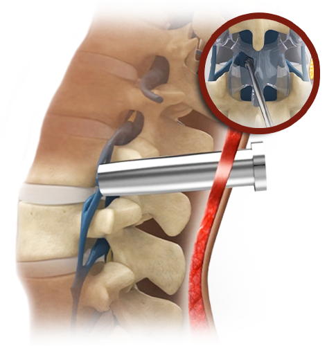 Microcirurgia Tubular