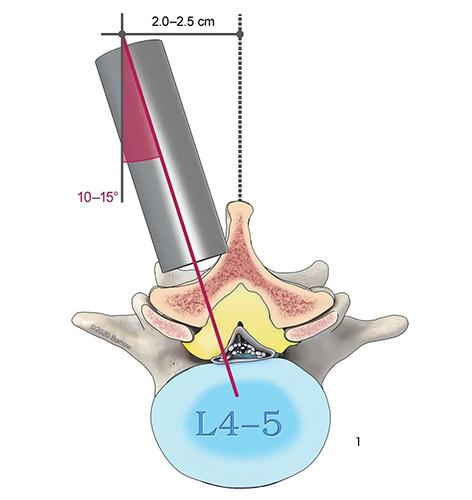 Microcirurgia para Hérnia Discal