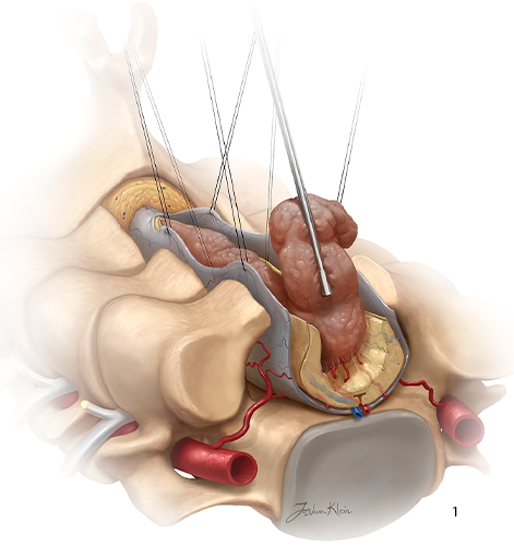 Ressecção de Tumor Medular
