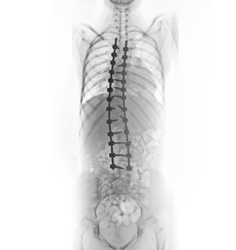 Tratamento Cirúrgico da Escoliose